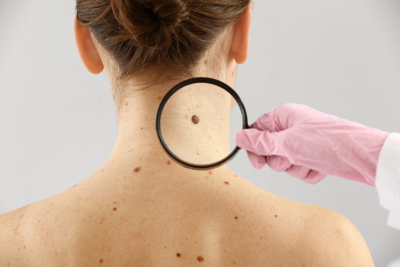 Imagen noticia Campaña para prevenir y detectar el cáncer de piel